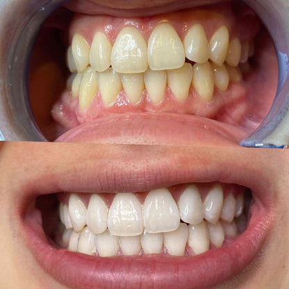 Mysmile whitiening kits